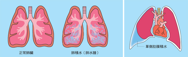 图片搜寻 肺积水