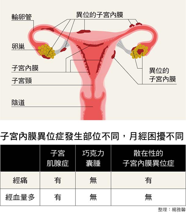 3大药物改善子宫内膜异位症