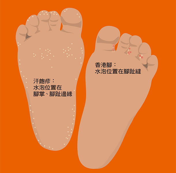 如何分辨汗疱疹与香港脚?