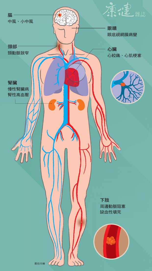 血管阻塞,全身遭殃!-康健出版笔记-康健名家观点