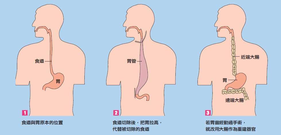 戒除危险因子 远离食道癌