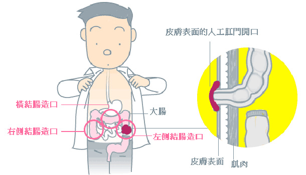 有造口要怎麼辦 康健雜誌